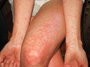 Maculopapular rash: starts on the face and then spreads throughout the body