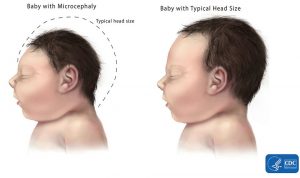 microcephaly-comparison-500px (1)