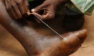 Guinea worm isae