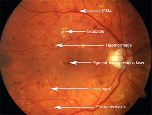 Diabetes-retinopathy